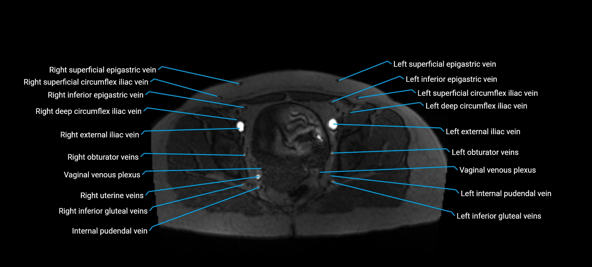 MRV abdomen pelvis & lower limb axial cross sectional anatomy labelled MRI image 171 (1).webp
